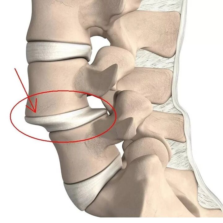 blessures vertébrales