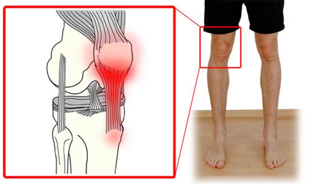 Tendinite - inflammation des tendons de l'articulation du genou