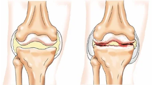 Chondromatous