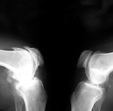 L'arthrose sur une radiographie