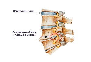 Les symptômes de l'arthrose cervicale