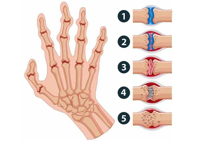 stades de développement de l'arthrite dans les articulations des doigts